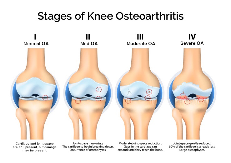 Four stages of knee osteoarthritis showing progressive cartilage loss from Stage I (Doubtful) to Stage IV (Severe)